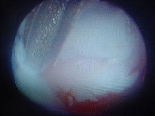 This is a picture of the a elbow joint via   arthroscopy.